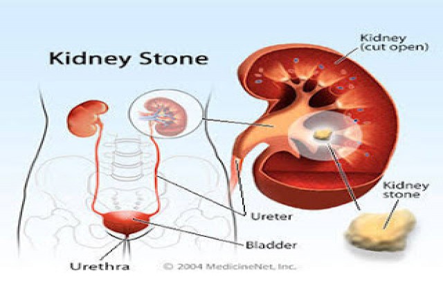 KIDNEY STONES KIDNEY STONES