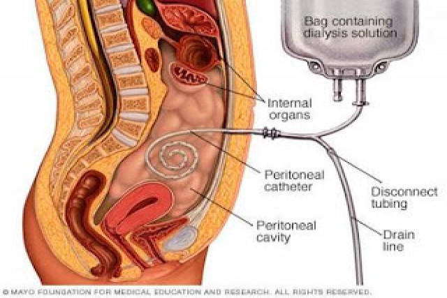 PERITONEAL DIALYSIS PERITONEAL DIALYSIS