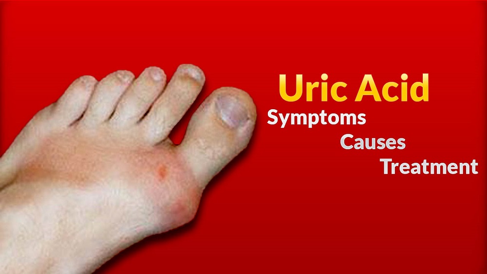 Facts about the Uric Acidity of Human Body Facts about the Uric Acidity of Human Body