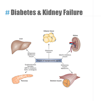 Diabetes and kidney failure