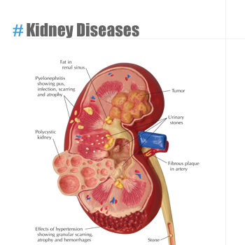 Kidney Diseases