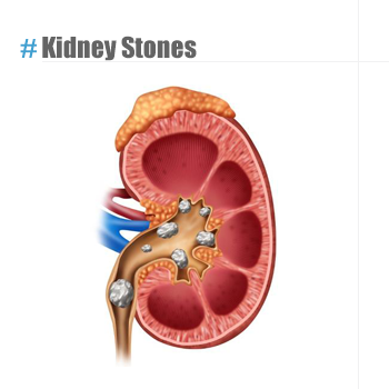 kidney stones
