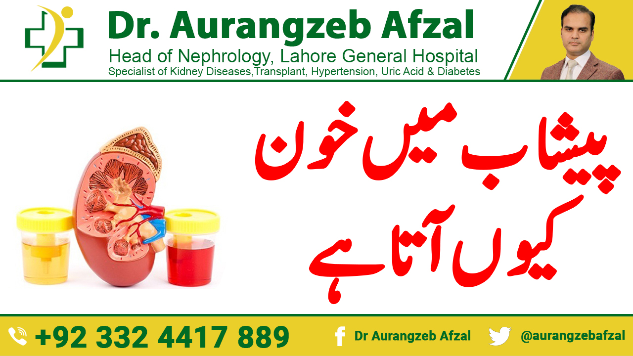 BLOOD in urine [Dangerous causes and investigations] in Urdu/Hindi