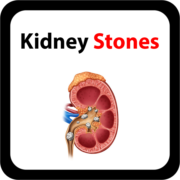 Kidney Stones