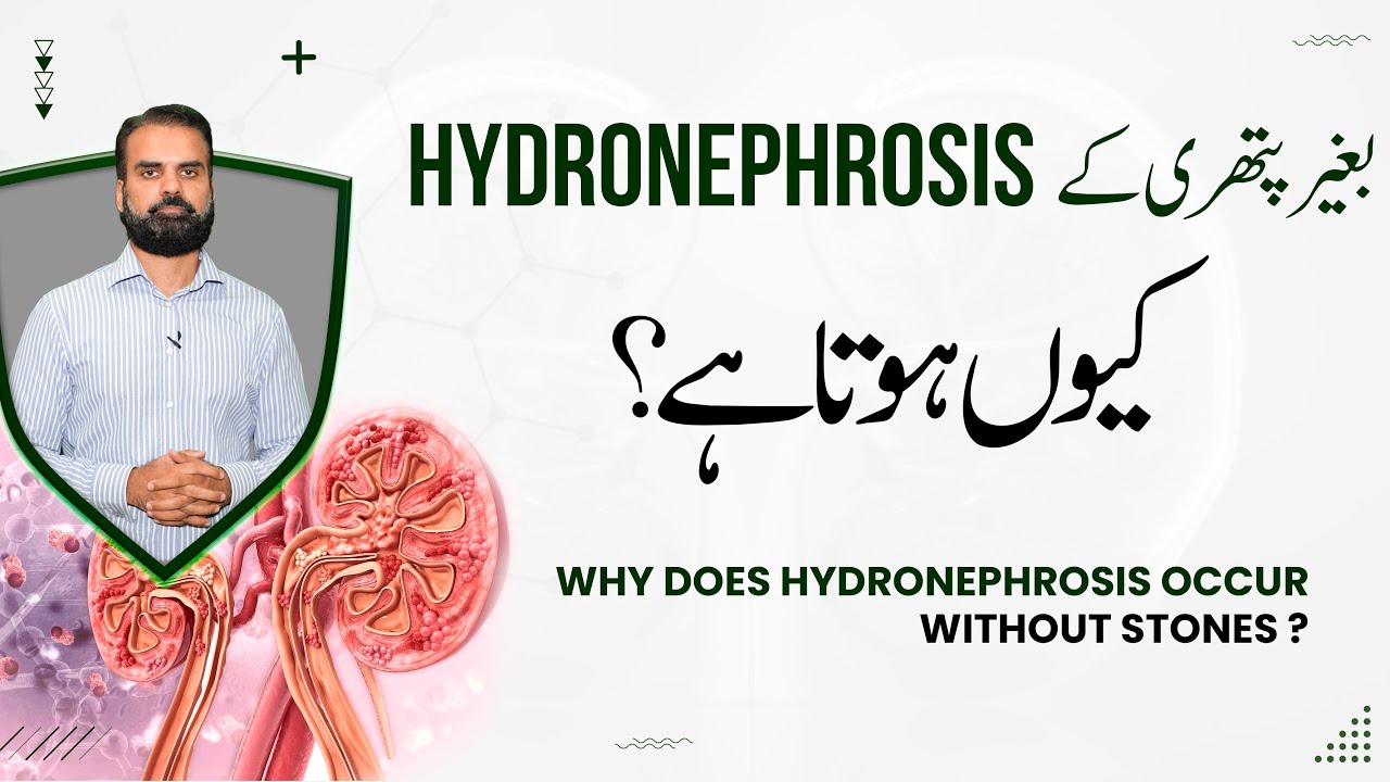 Pathri Ka Bagair Hydronephrosis | Hydronephrosis Without Kidney Stone Causes & Treatment in Urdu
