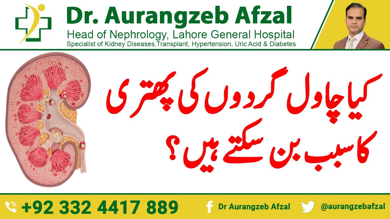 Can RICE Cause Kidney Stones - What Causes Kidney Stones?