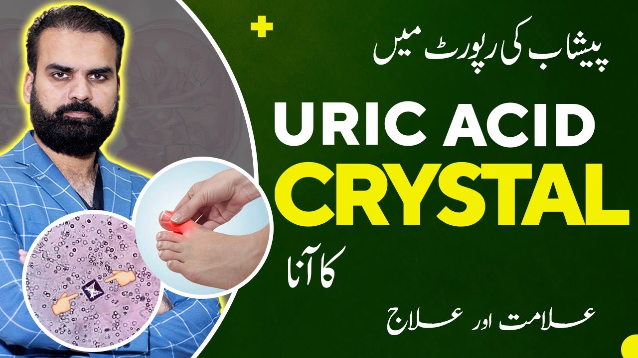Uric Acid Crystal in Urine Test Report Causes & Treatment in Urdu | Peshab Mein Crystal