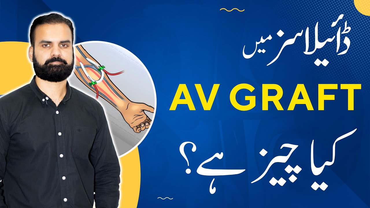 Graft in Dialysis | Dialysis Step & Procedure in Urdu