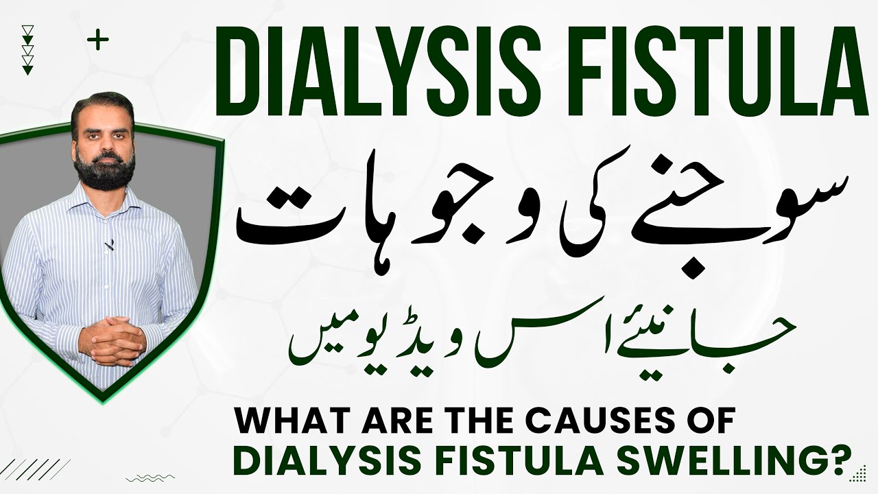 Dialysis Fistula or Dialysis Needle Area Swelling in Urdu | Kidney Dialysis Care in Urdu