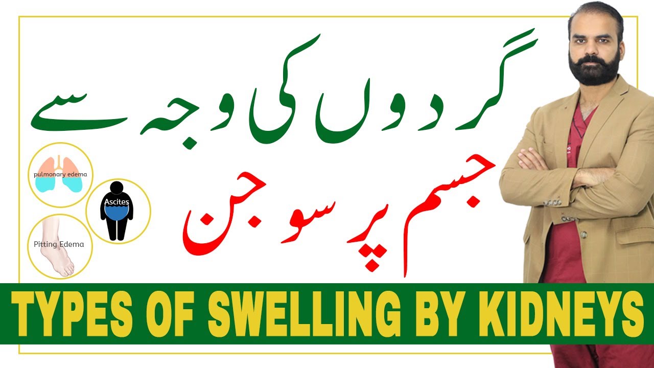 Types of Swelling by Kidneys, Understand the Difference ?Edema in Hindi/Urdu?