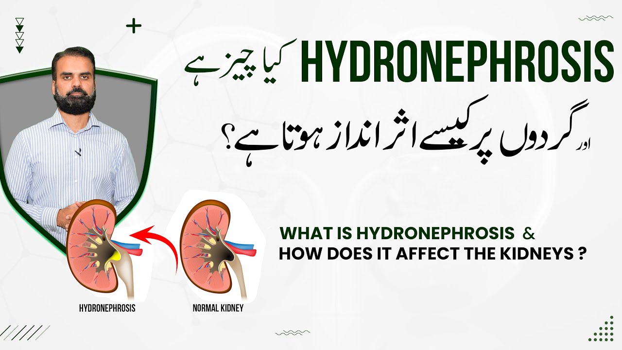 Hydronephrosis Kaya Hota Hai? | How Does Hydronephrosis Affect On the Kidney? - Dr. Aurangzeb Afzal