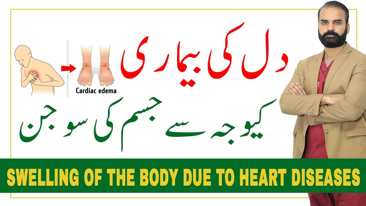 Swelling of body due to Heart disease ?Cardiac edema in Hindi/Urdu?