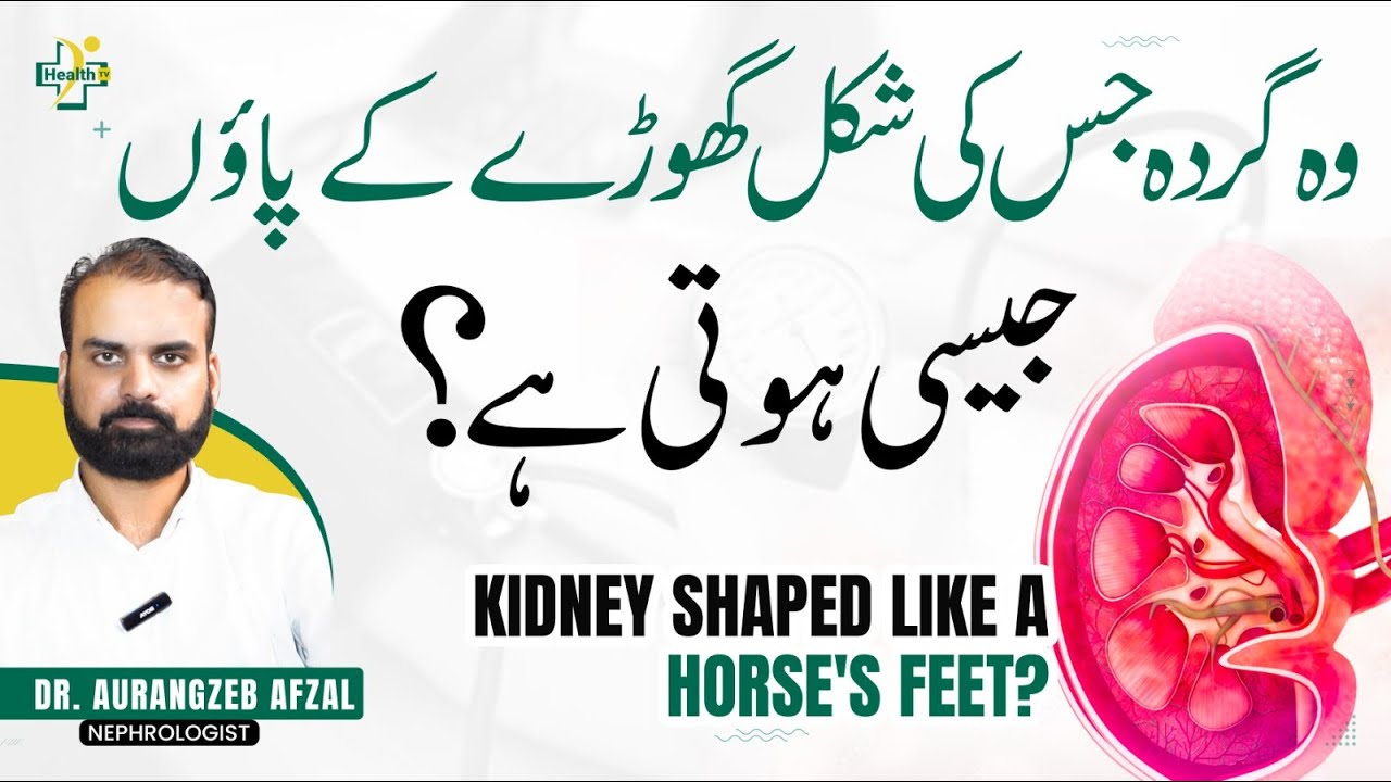 Horse Shoe Kidney Reasons & Treatment | Gurda Jis Ki Shakal Ghode Ky Paon Jasi Hoti Hai