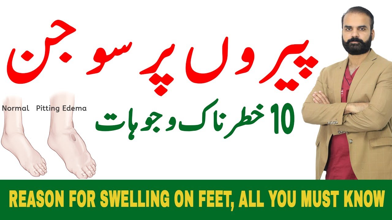 10 Dangerous Reasons for Swelling on Feet - What causes swollen legs and feet??Edema in Hindi/Urdu?