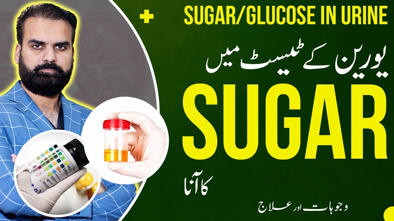 Glucose in Urine Test | Sugar Positive in Urine Causes & Treatment
